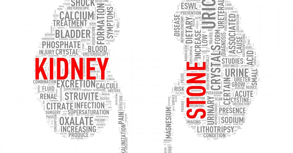 Everything you need to know about kidney stones | RxWiki