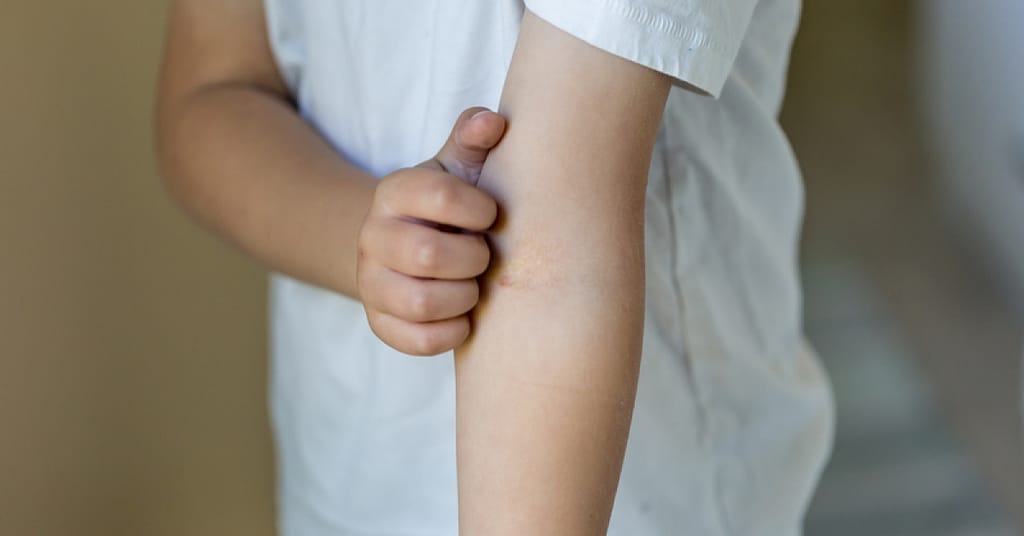 FDA approves Dupixent (dupilumab) to treat eczema starting at 6 months old | RxWiki