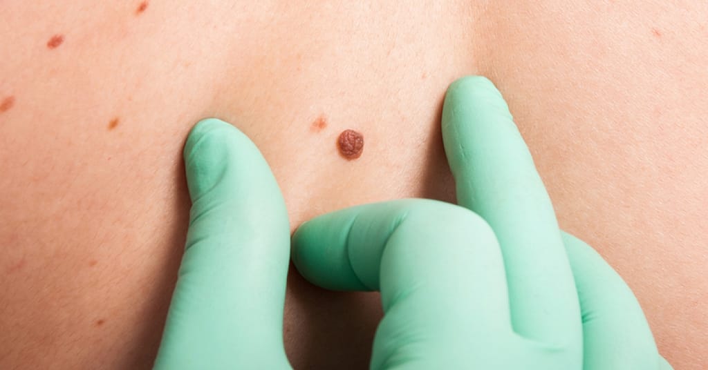 Health officials warn about products marketed for mole and skin lesion removal | RxWiki