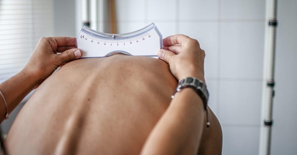 Here's everything you need to know about scoliosis | RxWiki