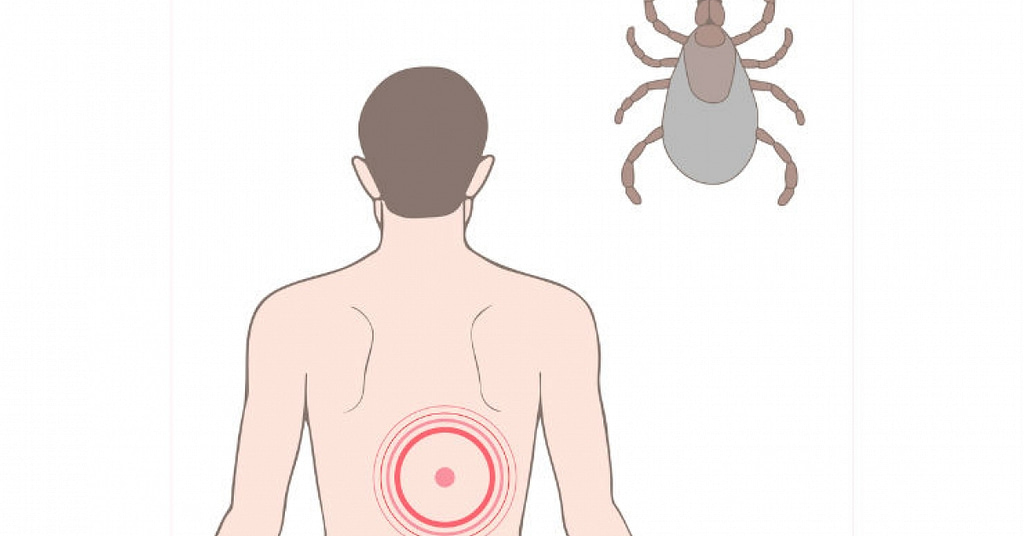 Five ways you can prevent dangerous tick bites this summer | RxWiki