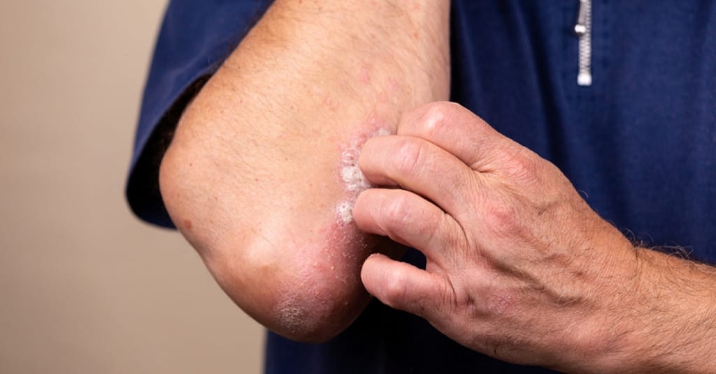 FDA approves Sotyktu (deucravacitinib) to treat plaque psoriasis  | RxWiki