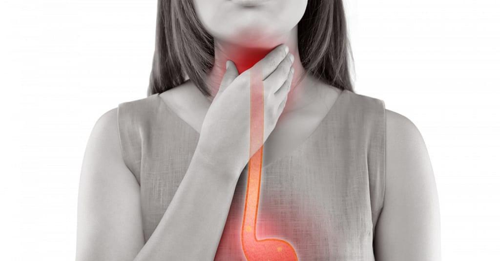 Everything you need to know about acid reflux | RxWiki