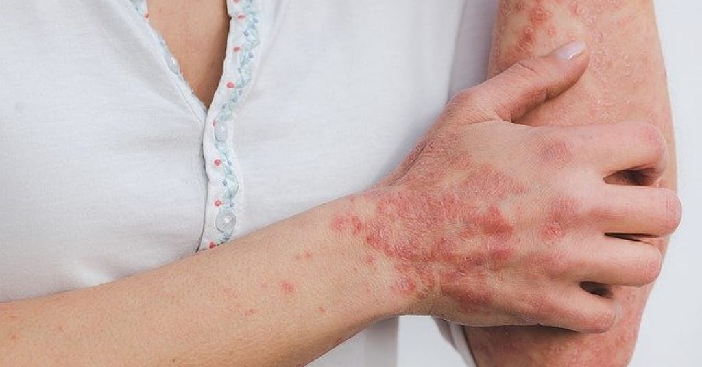 Here's everything you need to know for Psoriasis Awareness Month | RxWiki