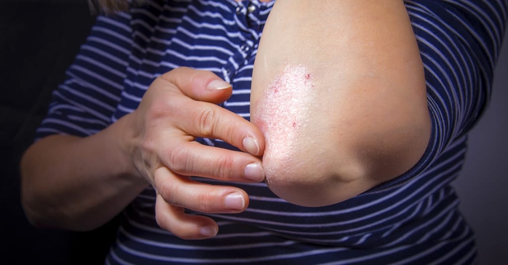 Everything you need to know about psoriasis | RxWiki